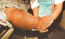 On estime qu’en Polynésie française près de 1.000 personnes sont atteinte d’éléphantiasis On estime qu’en Polynésie française près de 1.000 personnes sont atteinte d’éléphantiasis