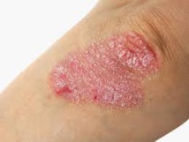 30% des Français ne feraient pas la bise à une personne atteinte de psoriasis
