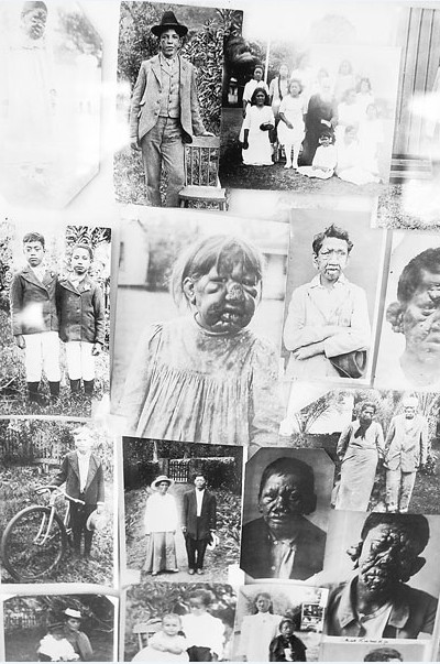 Emouvant montage de vieilles photos d’enfants lépreux de Kalawao et de Kalaupapa ; la lèpre avait fait son apparition vers 1820 à Hawaii, amenée par des travailleurs chinois. Les plus touchés furent les indigènes hawaiiens.