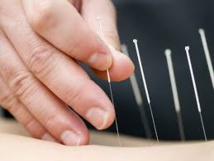 L'acupuncture pour sécher les larmes des bébés atteints de coliques (étude) L'acupuncture pour sécher les larmes des bébés atteints de coliques (étude)