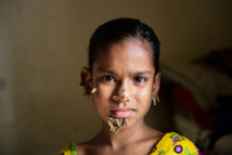 Bangladesh: opération réussie pour la "fille-arbre"