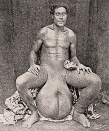 Tuméfaction du scrotum, Tahiti vers 1900