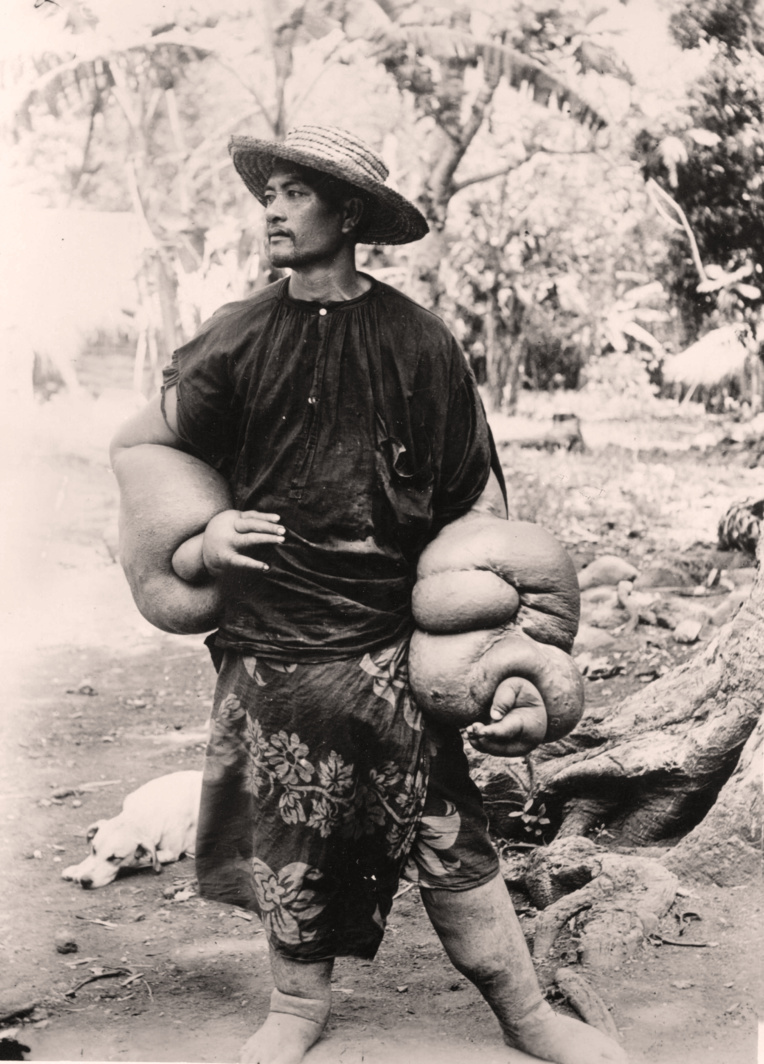 Cas d’éléphantiasis des bras, Tahiti vers 1950