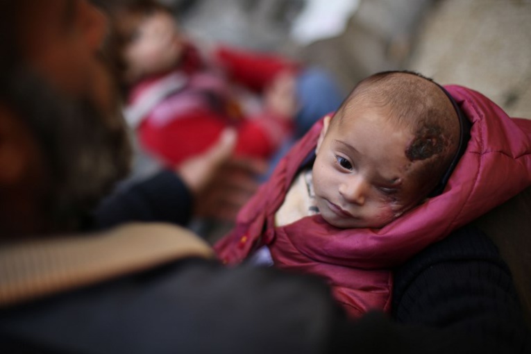 Syrie: un bébé devenu borgne après un raid, symbole sur le net Syrie: un bébé devenu borgne après un raid, symbole sur le net