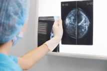 GB: une erreur dans le dépistage du cancer du sein aurait écourté 270 vies