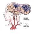 Un marqueur biologique permet de prédire avec fiabilité les cas d'Alzheimer (étude)