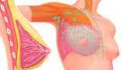 L'ablation préventive des seins réduit dans certains cas le risque de cancer