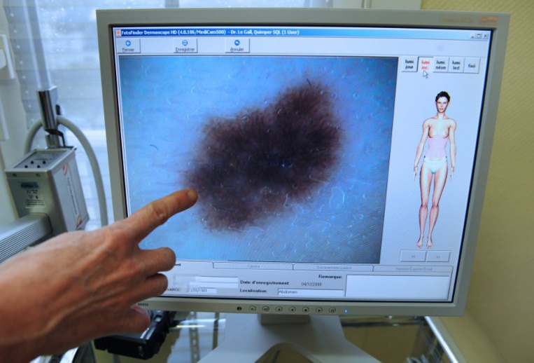 Australie: des chercheurs développent un test sanguin pour détecter le mélanome