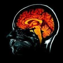 Alzheimer: le cerveau commencerait à se réduire 10 ans avant le diagnostic
