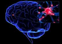 Alzheimer : des études pointent une relation avec des traumatismes cérébraux