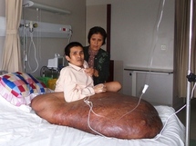 Un homme opéré d'une tumeur de 90 kilos au Vietnam