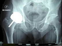 Prothèses de hanche : le dispositif médical de nouveau pris en défaut