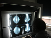 Cancers gynécologiques : La CPS prône une collaboration étroite avec la Santé