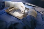 La banque de tissus, fournisseur méconnu des chirurgiens en os, peau ou cornée