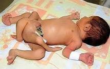 Les médecins pakistanais opèrent avec succès un bébé né avec six jambes