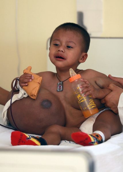 Mexique: un enfant de deux ans opéré d'une tumeur plus grosse que lui