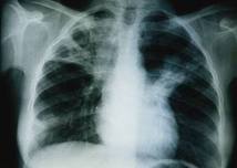 La tuberculose continue à reculer mais le combat reste "fragile"
