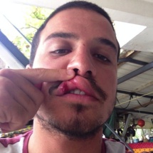 Le brésilien Ricardo Dos santos montre sa blessure après son altercation avec le Hawaien Jamie O'Brien
