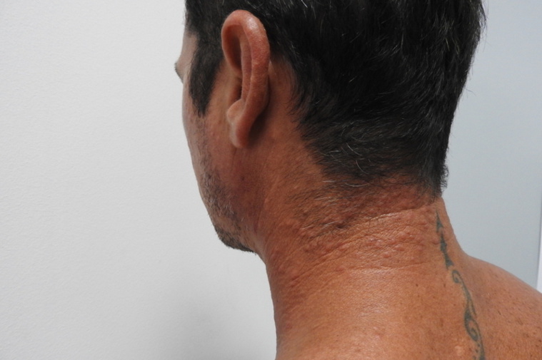 La dermatite du surfeur touche la côte ouest La dermatite du surfeur touche la côte ouest