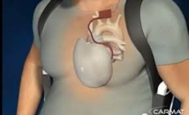 Coeur artificiel Carmat: du chemin à parcourir avant une commercialisation Coeur artificiel Carmat: du chemin à parcourir avant une commercialisation