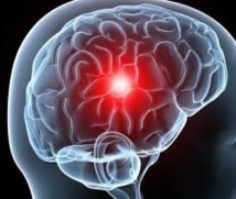 Attaque cérébrale: les femmes de tous les âges plus à risque que les hommes Attaque cérébrale: les femmes de tous les âges plus à risque que les hommes