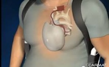 Décès du malade ayant bénéficié de la première implantation d'un coeur artificiel Carmat