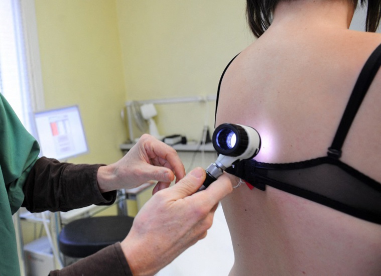 Diagnostic de mélanome Diagnostic de mélanome