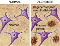 Un diagnostic précoce et simplifié de la maladie d'Alzheimer Un diagnostic précoce et simplifié de la maladie d'Alzheimer