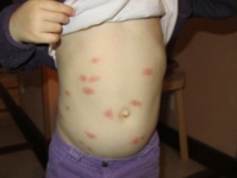 Chikungunya : comment remobiliser la population antillaise contre l'épidémie Chikungunya : comment remobiliser la population antillaise contre l'épidémie