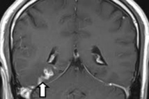 GB: un ver dans le cerveau à l'origine des maux de tête d'un patient