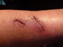 Les blessures occasionnées sur la touriste allemande à Moorea Les blessures occasionnées sur la touriste allemande à Moorea