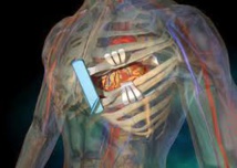 Le pontage coronarien meilleure option dans certains cas que l'angioplastie Le pontage coronarien meilleure option dans certains cas que l'angioplastie