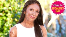 Nouvelle opération chirurgicale pour Turia Pitt