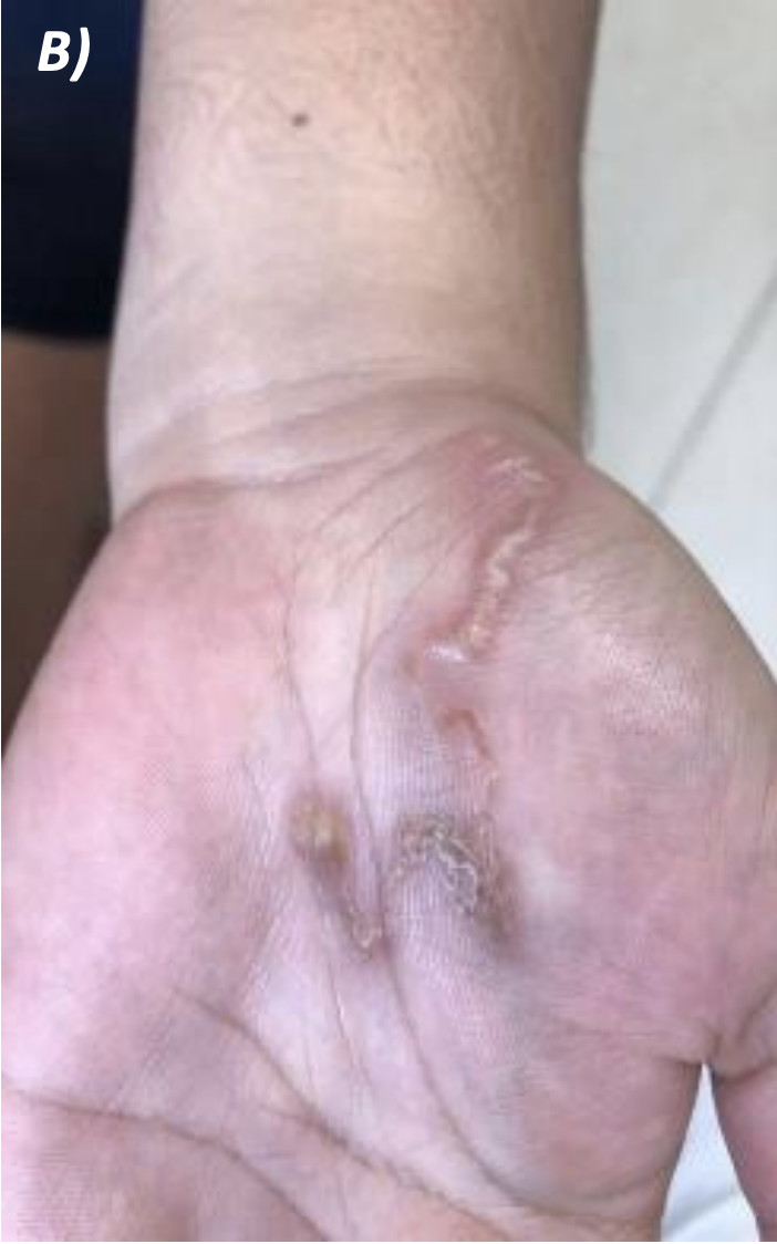 4 cas de larva migrans