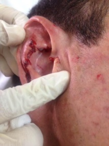 Rikitea : Il mord sa victime au visage Rikitea : Il mord sa victime au visage