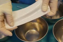 Implants: interdiction d'un produit pour la reconstruction mammaire Implants: interdiction d'un produit pour la reconstruction mammaire