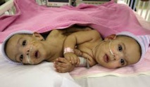 Des bébés siamois afghans séparés avec succès à Kaboul