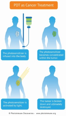 Stratégie révolutionnaire contre le cancer agressif Stratégie révolutionnaire contre le cancer agressif