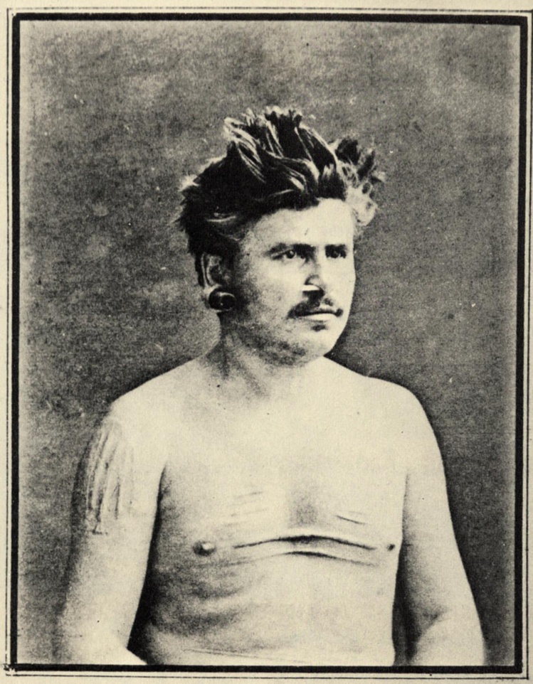 1 Narcisse Pelletier à son retour en France : il portait des scarifications sur le torse et les bras ; son nez et ses oreilles étaient largement percées.