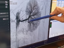 Une nouvelle alternative pour l’hypertension artérielle sévère Une nouvelle alternative pour l’hypertension artérielle sévère