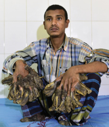 Bangladesh: un "homme-arbre" aux excroissances impressionnantes opéré Bangladesh: un "homme-arbre" aux excroissances impressionnantes opéré