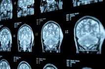 Un haut niveau d'études serait associé à un risque accru de tumeurs du cerveau Un haut niveau d'études serait associé à un risque accru de tumeurs du cerveau