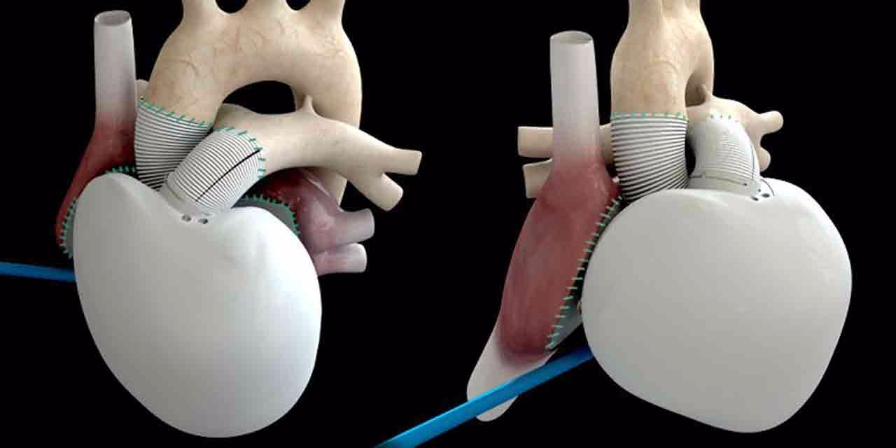 Carmat implante un premier coeur artificiel dans le cadre d'une nouvelle étude