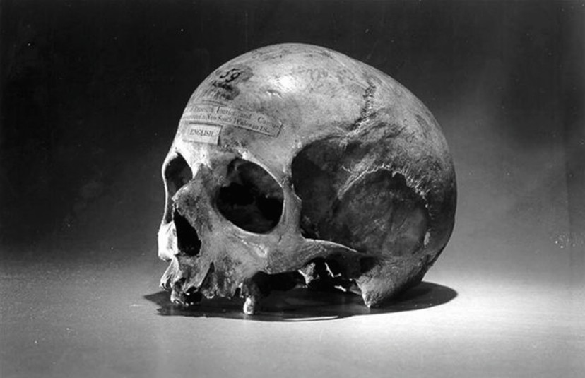 Le crâne de l’Irlandais ; après sa mort, son corps fut entièrement disséqué, dans le but de savoir si une anomalie physique pouvait expliquer ce cas de cannibalisme.