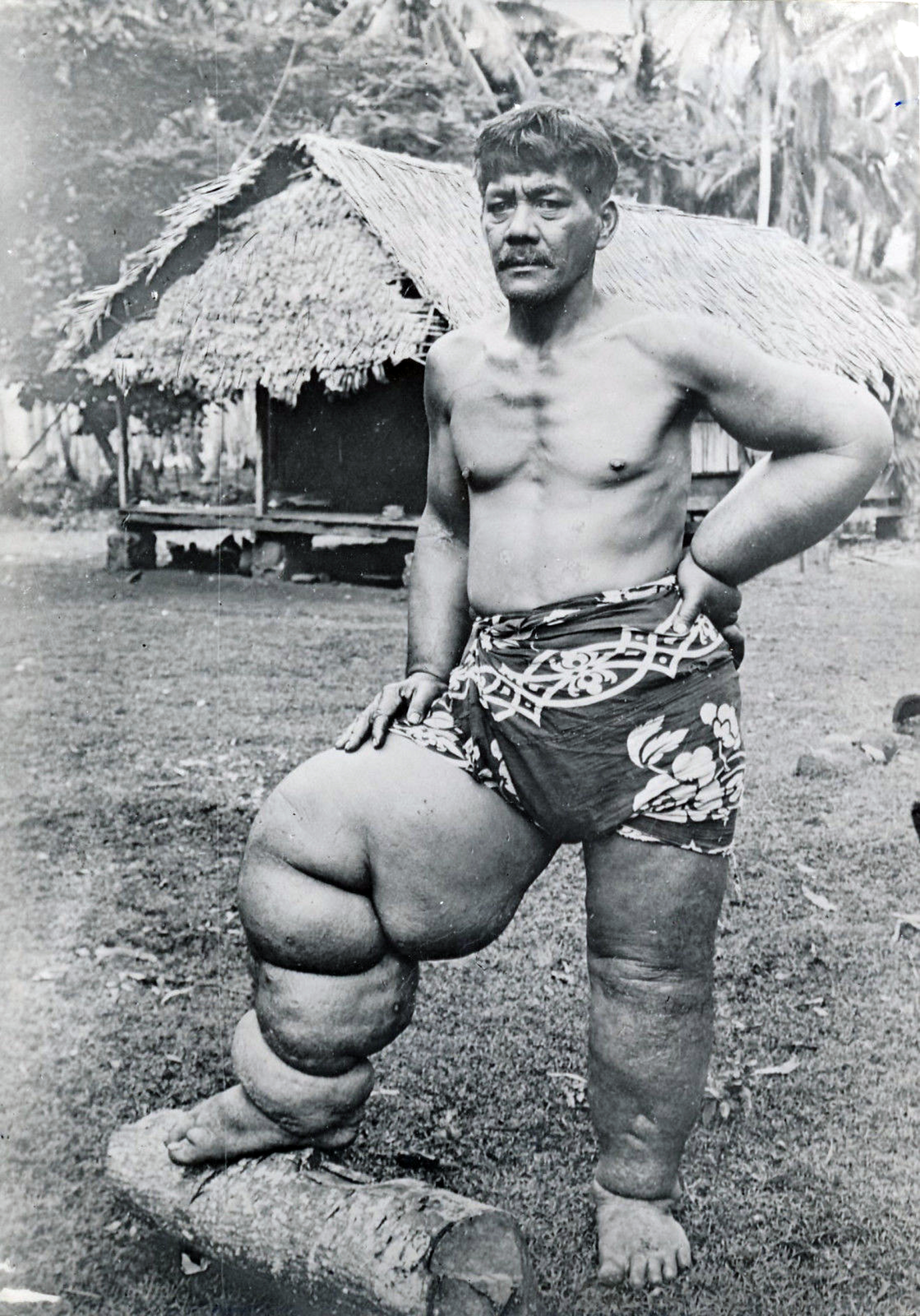 Eléphantiasis des jambes, Tahiti 1940