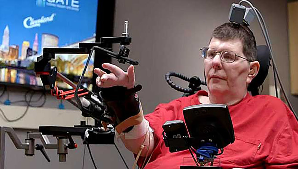 Totalement paralysé, il réussit à se servir de son bras grâce à des implants cérébraux