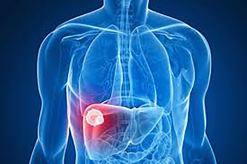 325 millions de personnes touchées par l'hépatite (OMS)