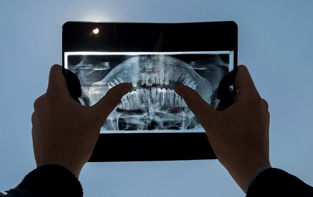 Les femmes souffrant d'infection chronique des gencives ont un risque accru de cancer