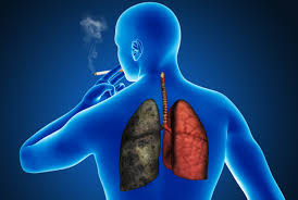 Sida: les fumeurs ont un risque nettement plus élevé de décéder d'un cancer pulmonaire