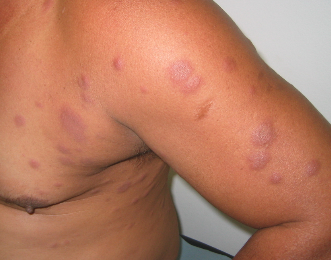 "En général, la lèpre donne des taches sur la peau, qui ne grattent pas et qui ne font pas mal", décrit taote Lam N'Guyen.